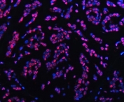 Immunofluorescent staining of FFPE human breast cancer tissue with TRMT6 antibody (red) and DAPI nuclear stain (blue). HIER: steam section in pH8 EDTA buffer for 20 min.