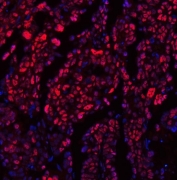 Immunofluorescent staining of FFPE human ovarian cancer tissue with TRMT6 antibody (red) and DAPI nuclear stain (blue). HIER: steam section in pH8 EDTA buffer for 20 min.