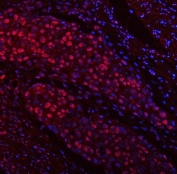 Immunofluorescent staining of FFPE human esophageal squamous cell carcinoma tissue with TRMT6 antibody (red) and DAPI nuclear stain (blue). HIER: steam section in pH8 EDTA buffer for 20 min.