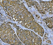 IHC staining of FFPE human liver cancer tissue with TMC7 antibody. HIER: boil tissue sections in pH8 EDTA for 20 min and allow to cool before testing.