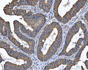 IHC staining of FFPE human colorectal adenocarcinoma tissue with TMC7 antibody. HIER: boil tissue sections in pH8 EDTA for 20 min and allow to cool before testing.