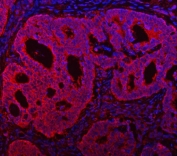 Immunofluorescent staining of FFPE human intestinal cancer with TMC7 antibody (red) and DAPI nuclear stain (blue). HIER: steam section in pH8 EDTA buffer for 20 min.