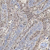 IHC staining of FFPE human laryngeal carcinoma tissue with SAGE1 antibody. HIER: boil tissue sections in pH8 EDTA for 20 min and allow to cool before testing.