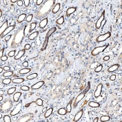 IHC staining of FFPE human renal cancer tissue with Lactadherin antibody. HIER: boil tissue sections in pH8 EDTA for 20 min and allow to cool before testing.