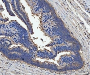 IHC staining of FFPE human colorectal adenocarcinoma tissue with Lactadherin antibody. HIER: boil tissue sections in pH8 EDTA for 20 min and allow to cool before testing.