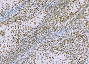 IHC staining of FFPE human laryngeal squamous cell carcinoma tissue with C-terminal-binding protein 2 antibody. HIER: boil tissue sections in pH8 EDTA for 20 min and allow to cool before testing.