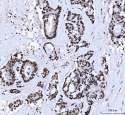 IHC staining of FFPE human colorectal adenocarcinoma tissue with C-terminal-binding protein 2 antibody. HIER: boil tissue sections in pH8 EDTA for 20 min and allow to cool before testing.