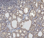 IHC staining of FFPE human thyroid cancer tissue with C-terminal-binding protein 2 antibody. HIER: boil tissue sections in pH8 EDTA for 20 min and allow to cool before testing.