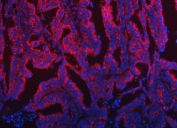 Immunofluorescent staining of FFPE human ovarian cancer tissue with TOM1L1 antibody (red) and DAPI nuclear stain (blue). HIER: steam section in pH8 EDTA buffer for 20 min.