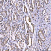 IHC staining of FFPE human prostate adenocarcinoma tissue with TOM1L1 antibody. HIER: boil tissue sections in pH8 EDTA for 20 min and allow to cool before testing.