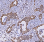 IHC staining of FFPE human colorectal adenocarcinoma tissue with TRIM16 antibody. HIER: boil tissue sections in pH8 EDTA for 20 min and allow to cool before testing.