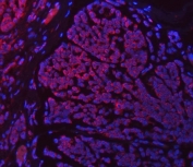 Immunofluorescent staining of FFPE human breast cancer tissue with SETD3 antibody (red) and DAPI nuclear stain (blue). HIER: steam section in pH8 EDTA buffer for 20 min.