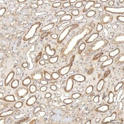 IHC staining of FFPE human renal cancer tissue with SGCE antibody. HIER: boil tissue sections in pH8 EDTA for 20 min and allow to cool before testing.