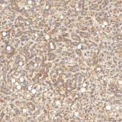 IHC staining of FFPE human liver cancer tissue with SGCE antibody. HIER: boil tissue sections in pH8 EDTA for 20 min and allow to cool before testing.