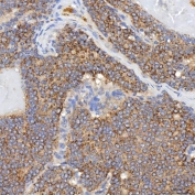 IHC staining of FFPE human breast cancer tissue with SGCE antibody. HIER: boil tissue sections in pH8 EDTA for 20 min and allow to cool before testing.