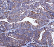 IHC staining of FFPE human endometrial adenocarcinoma tissue with TRIM71 antibody. HIER: boil tissue sections in pH8 EDTA for 20 min and allow to cool before testing.