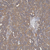 IHC staining of FFPE human ovarian serous cancer tissue with SEC31A antibody. HIER: boil tissue sections in pH8 EDTA for 20 min and allow to cool before testing.