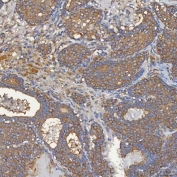 IHC staining of FFPE human breast cancer tissue with SEC31A antibody. HIER: boil tissue sections in pH8 EDTA for 20 min and allow to cool before testing.