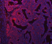 Immunofluorescent staining of FFPE human ovarian cancer tissue with SEC31A antibody (red) and DAPI nuclear stain (blue). HIER: steam section in pH8 EDTA buffer for 20 min.