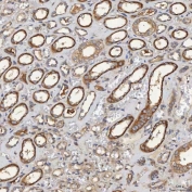 IHC staining of FFPE human renal cancer tissue with SEC31A antibody. HIER: boil tissue sections in pH8 EDTA for 20 min and allow to cool before testing.