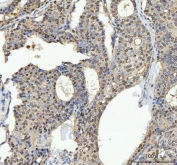 IHC staining of FFPE human breast cancer tissue with TRPS1 antibody. HIER: boil tissue sections in pH8 EDTA for 20 min and allow to cool before testing.