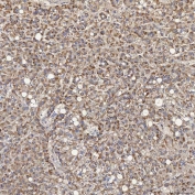 IHC staining of FFPE human liver cancer tissue with Acyl-CoA dehydrogenase family member 9 antibody. HIER: boil tissue sections in pH8 EDTA for 20 min and allow to cool before testing.