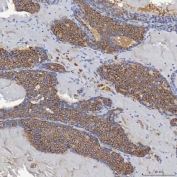 IHC staining of FFPE human breast cancer tissue with Acyl-CoA dehydrogenase family member 9 antibody. HIER: boil tissue sections in pH8 EDTA for 20 min and allow to cool before testing.