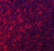 Immunofluorescent staining of FFPE human breast cancer tissue with Acyl-CoA dehydrogenase family member 9 antibody (red) and DAPI nuclear stain (blue). HIER: steam section in pH8 EDTA buffer for 20 min.