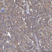 IHC staining of FFPE human ovarian serous cancer tissue with Acyl-CoA dehydrogenase family member 9 antibody. HIER: boil tissue sections in pH8 EDTA for 20 min and allow to cool before testing.