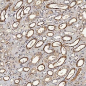 IHC staining of FFPE human renal cancer tissue with Acyl-CoA dehydrogenase family member 9 antibody. HIER: boil tissue sections in pH8 EDTA for 20 min and allow to cool before testing.