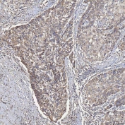 IHC staining of FFPE human larynx squamous cell carcinoma tissue with Acyl-CoA dehydrogenase family member 9 antibody. HIER: boil tissue sections in pH8 EDTA for 20 min and allow to cool before testing.