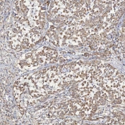 IHC staining of FFPE human lung adenocarcinoma tissue with Acyl-CoA dehydrogenase family member 9 antibody. HIER: boil tissue sections in pH8 EDTA for 20 min and allow to cool before testing.