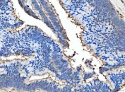 IHC staining of FFPE human colorectal adenocarcinoma tissue with MFG-E8 antibody. HIER: boil tissue sections in pH8 EDTA for 20 min and allow to cool before testing.