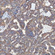 IHC staining of FFPE human thyroid cancer tissue with SEC23IP antibody. HIER: boil tissue sections in pH8 EDTA for 20 min and allow to cool before testing.