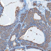 IHC staining of FFPE human breast cancer tissue with SEC23IP antibody. HIER: boil tissue sections in pH8 EDTA for 20 min and allow to cool before testing.