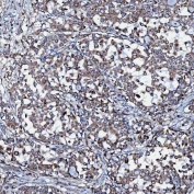 IHC staining of FFPE human lung adenocarcinoma tissue with SEC23IP antibody. HIER: boil tissue sections in pH8 EDTA for 20 min and allow to cool before testing.