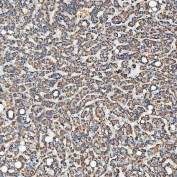 IHC staining of FFPE human liver cancer tissue with SEC23IP antibody. HIER: boil tissue sections in pH8 EDTA for 20 min and allow to cool before testing.