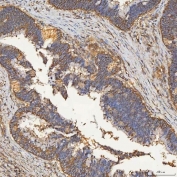 IHC staining of FFPE human colon adenocarcinoma tissue with SEC23IP antibody. HIER: boil tissue sections in pH8 EDTA for 20 min and allow to cool before testing.
