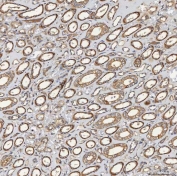 IHC staining of FFPE human renal cancer tissue with SEC23IP antibody. HIER: boil tissue sections in pH8 EDTA for 20 min and allow to cool before testing.