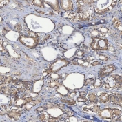 IHC staining of FFPE human prostate adenocarcinoma tissue with SEC23IP antibody. HIER: boil tissue sections in pH8 EDTA for 20 min and allow to cool before testing.