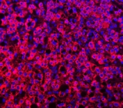 Immunofluorescent staining of FFPE human liver cancer with TTLL2 antibody (red) and DAPI nuclear stain (blue). HIER: steam section in pH8 EDTA buffer for 20 min.