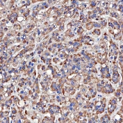 IHC staining of FFPE human liver cancer tissue with TTLL2 antibody. HIER: boil tissue sections in pH8 EDTA for 20 min and allow to cool before testing.