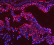 Immunofluorescent staining of FFPE human rectal cancer tissue with Selenium Binding Protein antibody (red) and DAPI nuclear stain (blue). HIER: steam section in pH8 EDTA buffer for 20 min.