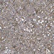 IHC staining of FFPE human liver cancer tissue with Semaphorin-4F antibody. HIER: boil tissue sections in pH8 EDTA for 20 min and allow to cool before testing.