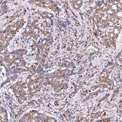 IHC staining of FFPE human lung adenocarcinoma tissue with SERAC1 antibody. HIER: boil tissue sections in pH8 EDTA for 20 min and allow to cool before testing.