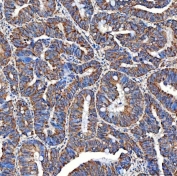 IHC staining of FFPE human rectum adenocarcinoma tissue with SERAC1 antibody. HIER: boil tissue sections in pH8 EDTA for 20 min and allow to cool before testing.