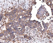 IHC staining of FFPE human ovarian serous adenocarcinoma tissue with SERAC1 antibody. HIER: boil tissue sections in pH8 EDTA for 20 min and allow to cool before testing.