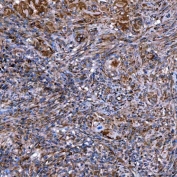 IHC staining of FFPE human larynx squamous cell carcinoma tissue with SERAC1 antibody. HIER: boil tissue sections in pH8 EDTA for 20 min and allow to cool before testing.
