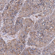 IHC staining of FFPE human liver cancer tissue with SERAC1 antibody. HIER: boil tissue sections in pH8 EDTA for 20 min and allow to cool before testing.