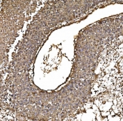IHC staining of FFPE human liver cancer tissue with Parkinson disease protein 7 antibody. HIER: boil tissue sections in pH8 EDTA for 20 min and allow to cool before testing.